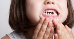 كيف أعالج تآكل الأسنان عند الأطفال؟